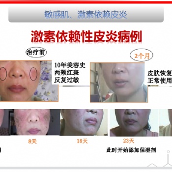 得了激素脸怎么办:正确对待戒断反应，广州怡嘉生物科技