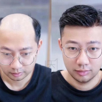 南阳假发定制提醒：脱发药广告别轻信，这个方法才**管用